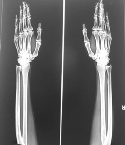 One-year after treatment: Improvement in bone density and healed fractures in both hands.